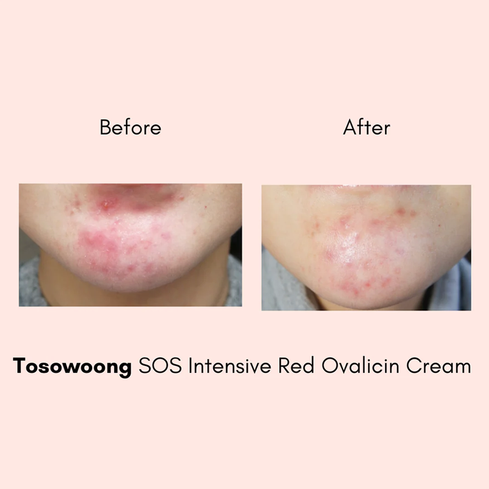 TOSOWOONG SOS Intensive Red Clinic Ovalicin Skin Clear Cream 50g - DODOSKIN